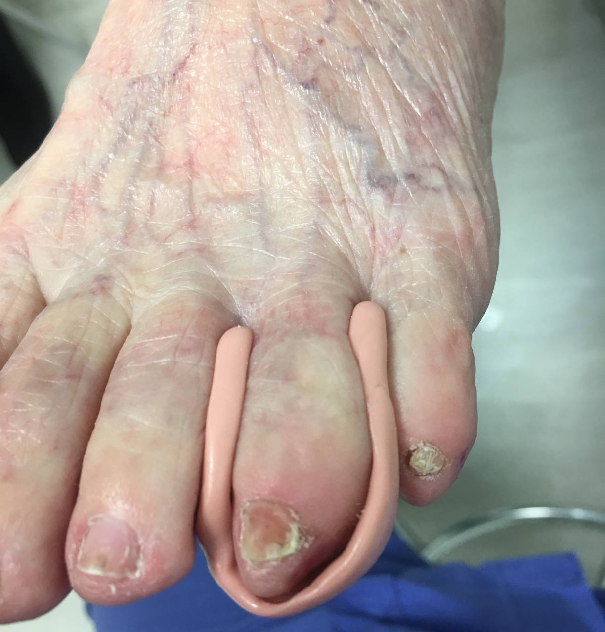 Ortoplastia